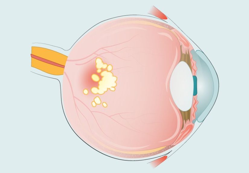 Geographic Atrophy (GA) Condition Progression Guide