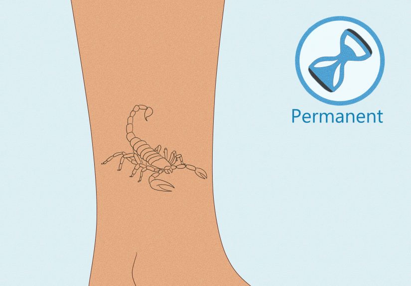 How to Get Rid of a Stick-and-Poke Tattoo: Expert Advice