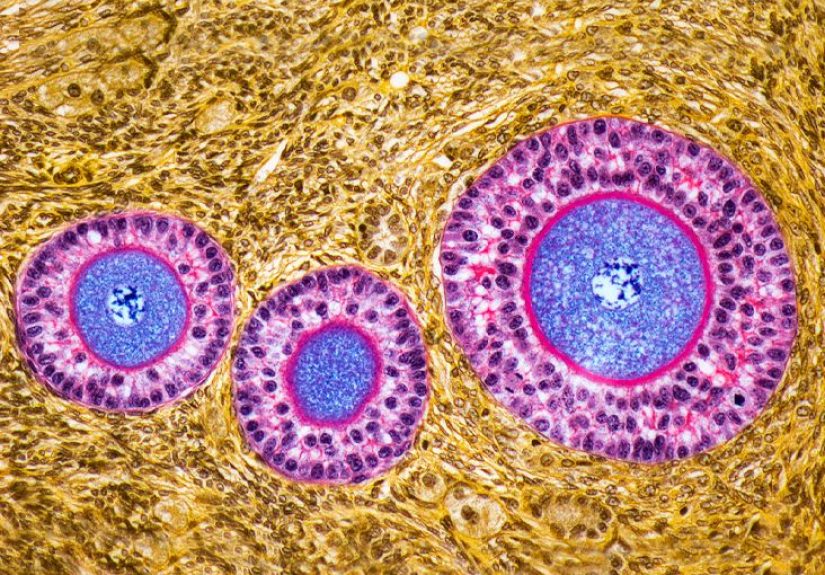 Premature Ovarian Failure: Treatment, Symptoms, and Diagnosis