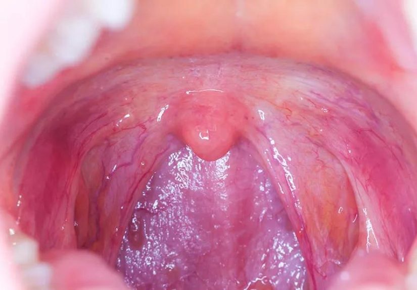 Throat Cancer’s Link to Oral Sex: What You Should Know