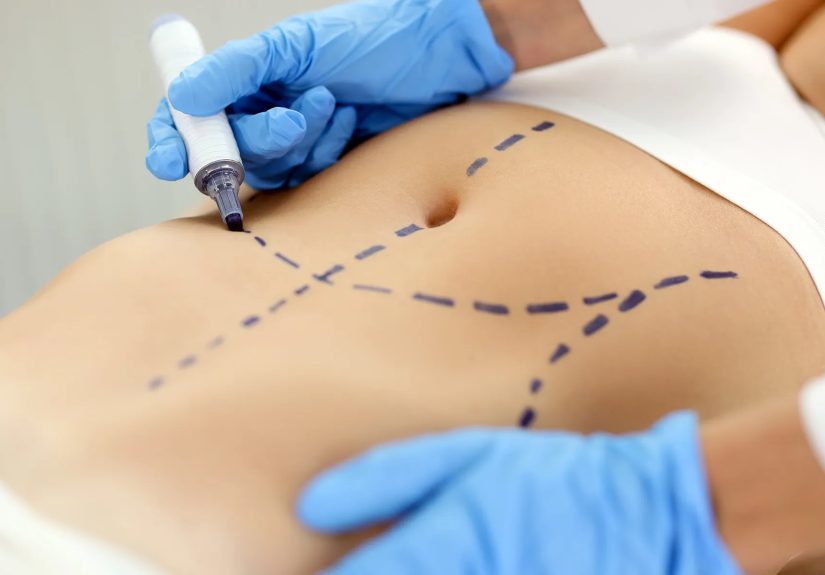 Tummy Tuck Procedure: What You Need to Know
