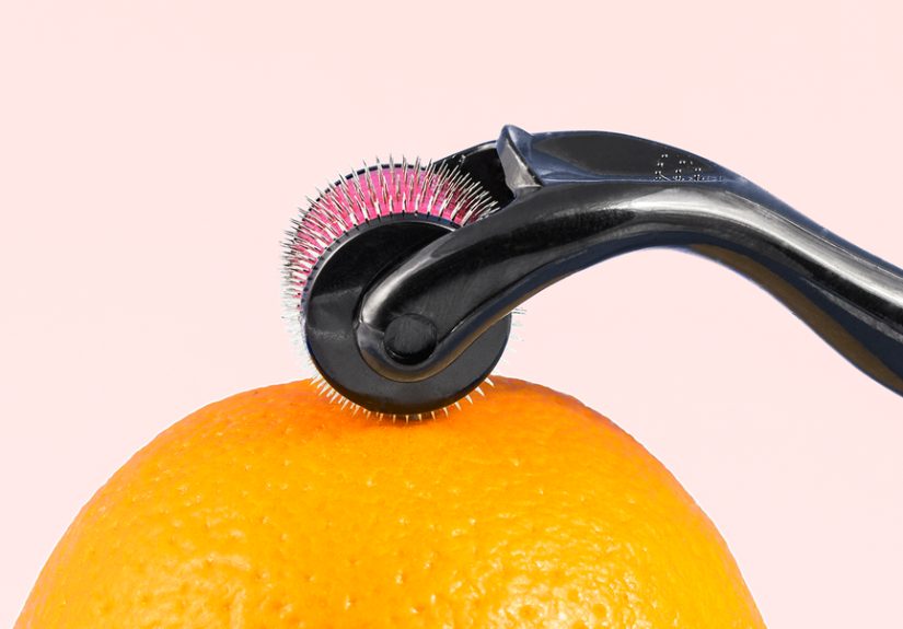 What Is Microneedling? Cost, Benefit, and Side Effects