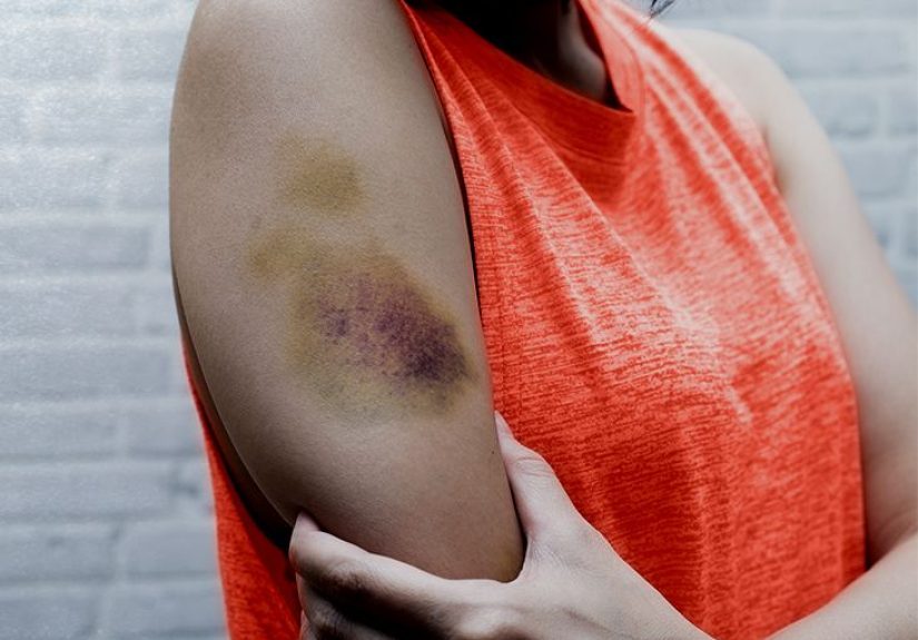 Why do I bruise easily? 8 Reasons it may happen