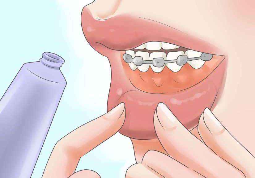 4 Ways to Deal With a Palate Expander