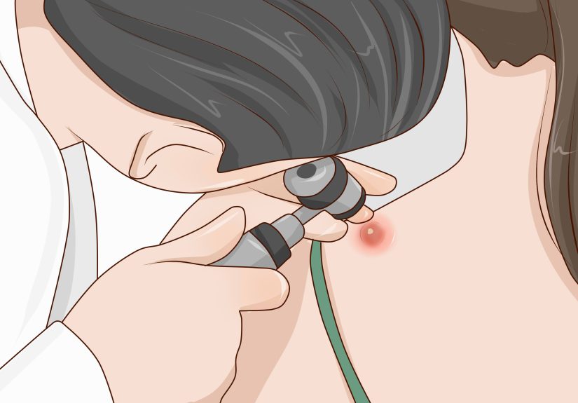4 Ways to Treat Boils at Home