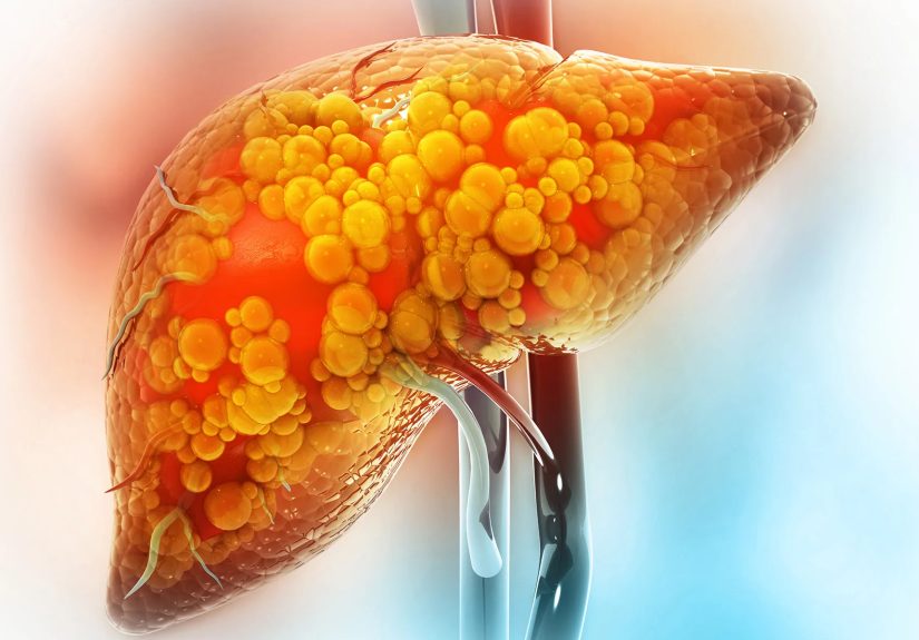 Alcohol-Related Liver Disease vs. Non-Alcohol-Related Liver Disease