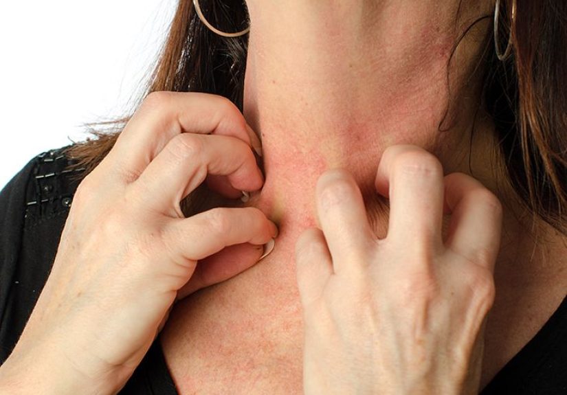 Anaphylaxis: Causes, Symptoms, and Diagnosis