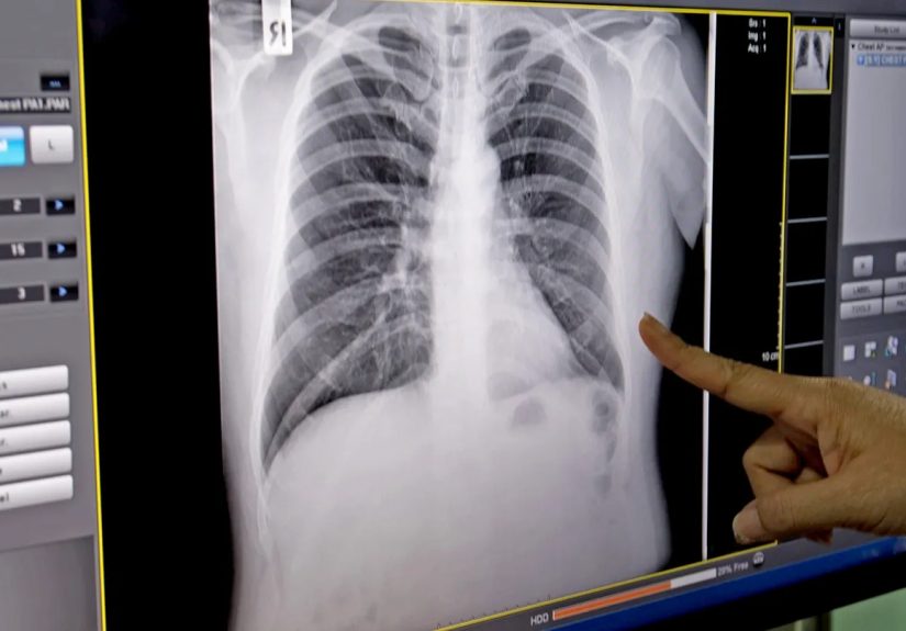 Common Symptoms of COPD and How It’s Diagnosed