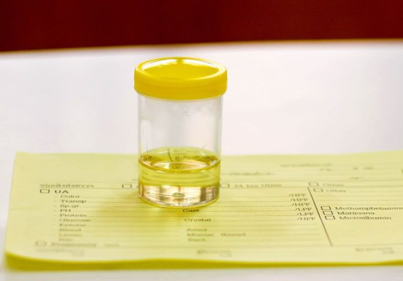 Cortisol Urine Test: Purpose, Types, and Results
