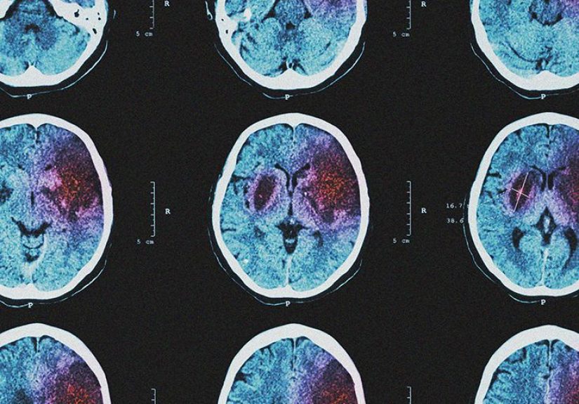 Hemorrhagic stroke: Causes, symptoms, treatments, prevention