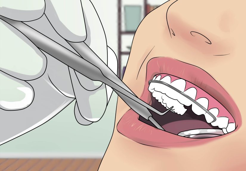 How to Talk With a Retainer: 9 Steps