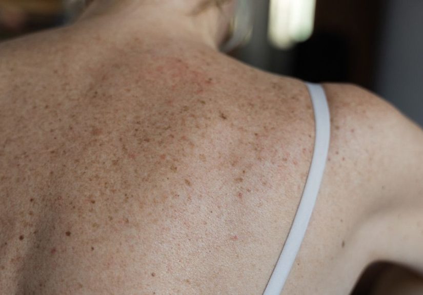 Nerve Paths That Shingles Follows: What to Know