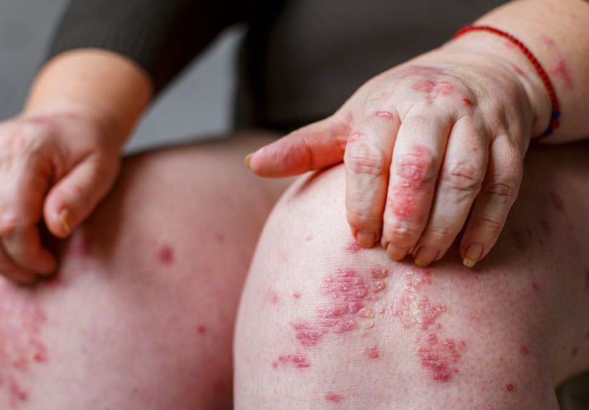 Psoriasis Rash: Pictures, Causes, Symptoms, and Treatment