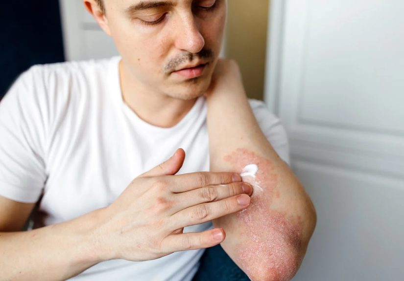 Topical Creams and Lotions to Treat Psoriasis