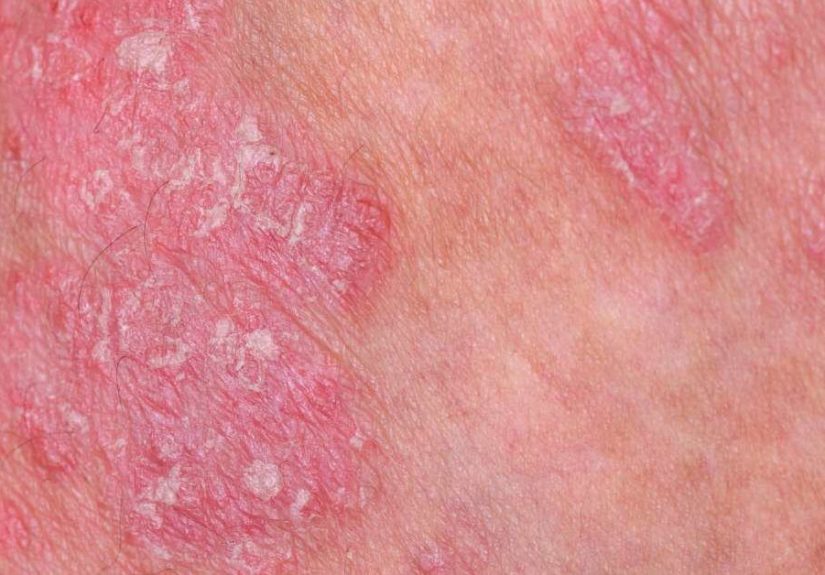 Vitaminas para la psoriasis: Beneficios y riesgos