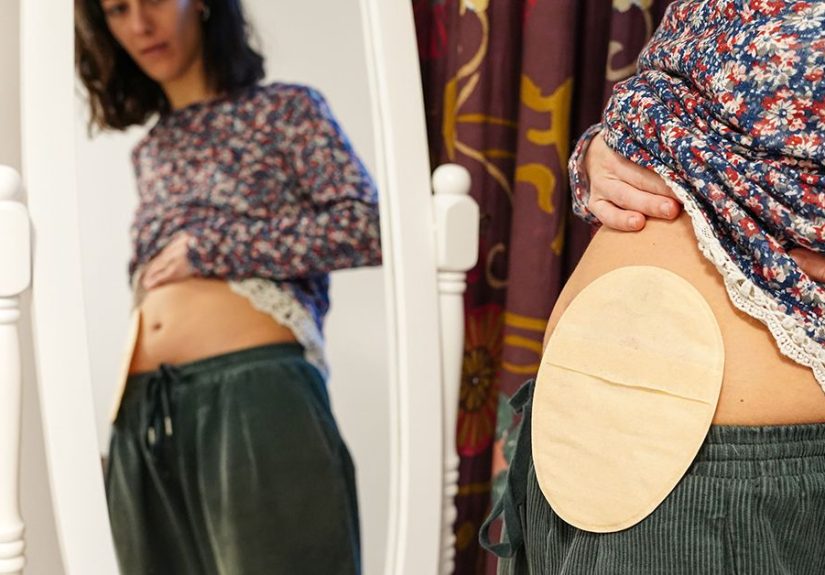 Body Image Issues When You Have an Ostomy Pouch