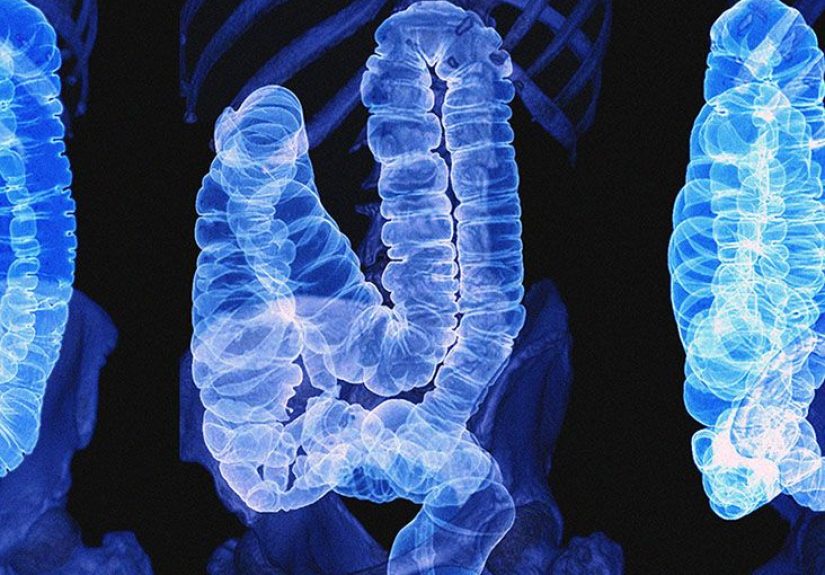 Colon Cancer: Symptoms, Stages, Causes, and Treatment