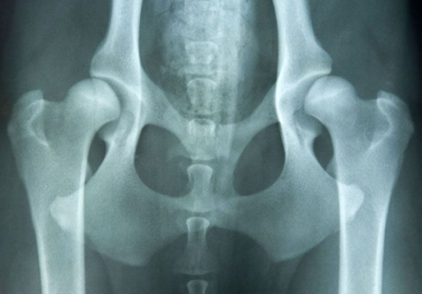 Congenital Hip Dislocation: Causes, Symptoms, and Diagnosis