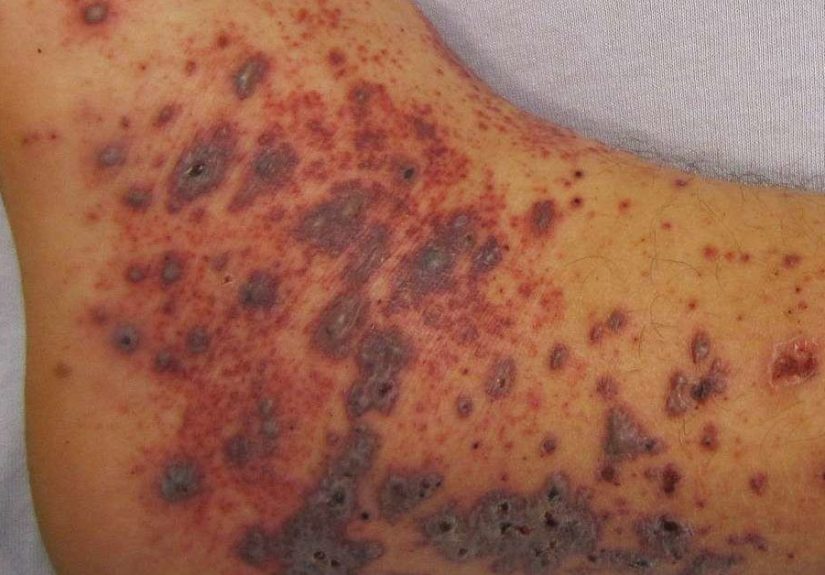 Petechiae: Causes and Treatments
