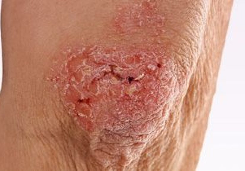 Psoriasis vs. Lichen Planus: What’s the Difference?