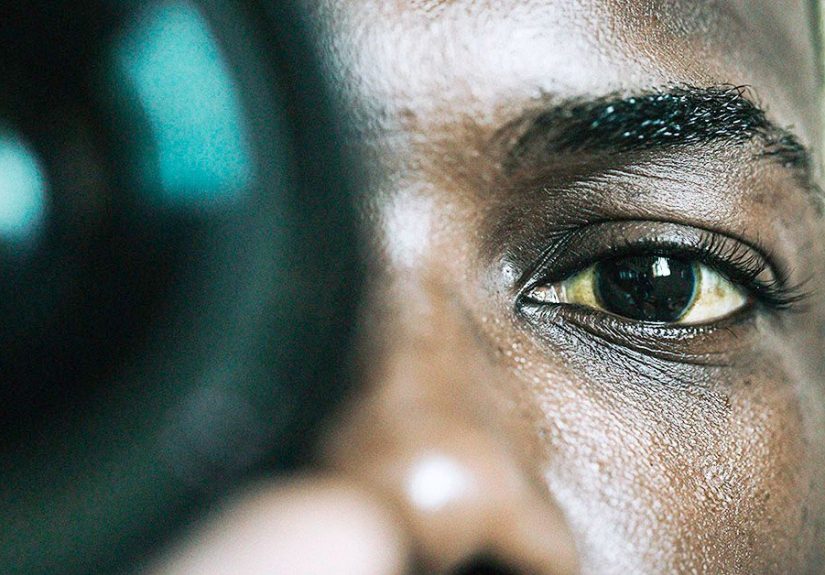 Scleral lenses for dry eye: Effectiveness, fitting, and tips