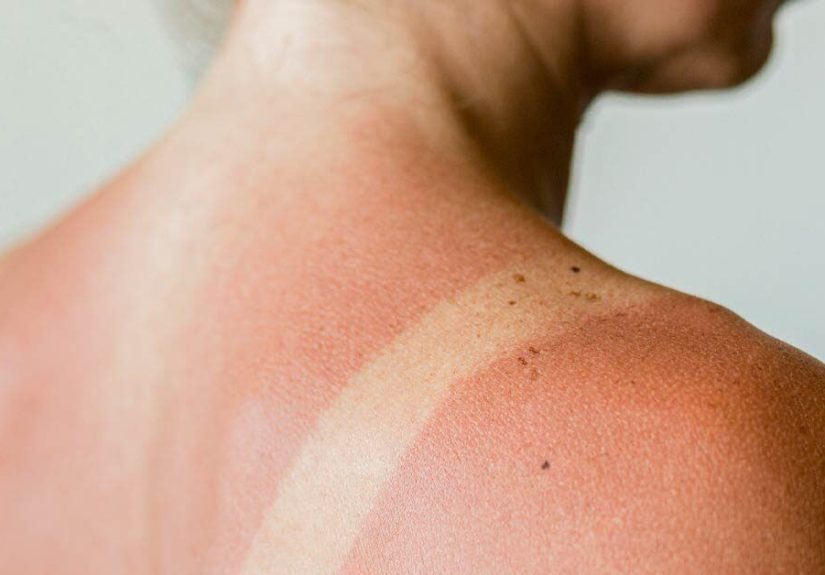 Sun Rash: Poisoning, Allergy, Treatment, Causes, Pictures, and More