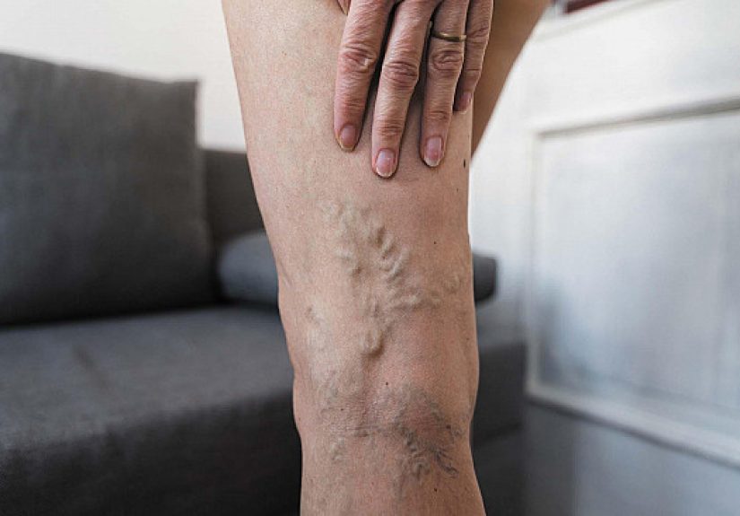 Varicose Veins: More than a Cosmetic Concern - Harvard Health