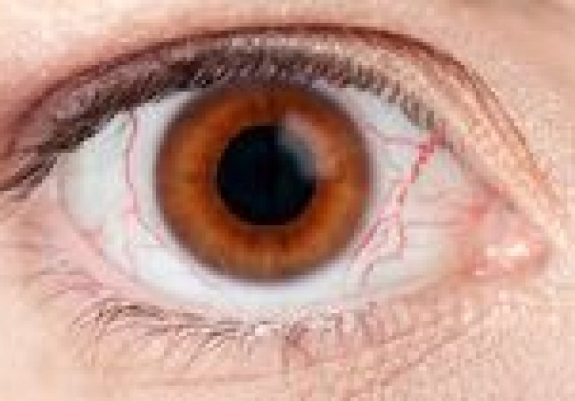 Dry Eyes: Causes, Treatment, and Prevention