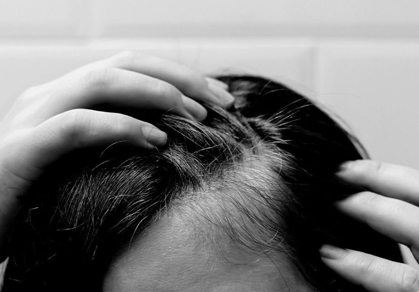 Endometriosis and Hair Loss: Causes and Finding Support