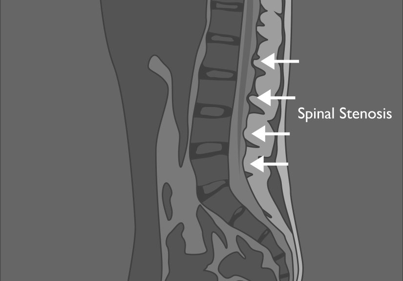 How to Read and Recognize Normal and Abnormal Lumbar MRI Results