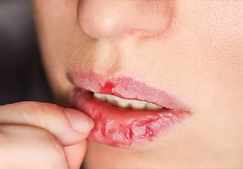 Picking, Pulling, Biting: Body Damaging Disorders