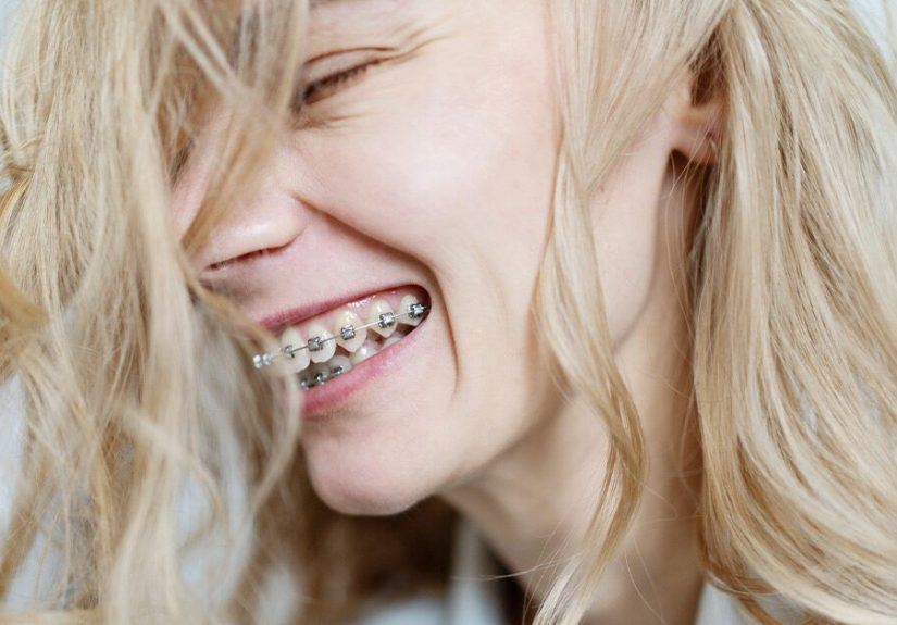 Self-Ligating Braces: How They Differ, Benefits, Cost
