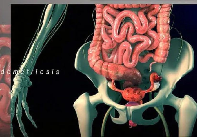 Talking to Your Doctor About Period Pain and Endometriosis