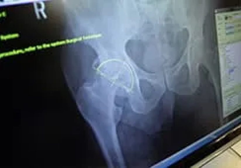 What Happens During a Total Hip Replacement Surgery