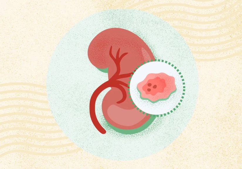 What Is Kidney Cancer? Symptoms, Causes, Diagnosis, Treatment, and Prevention